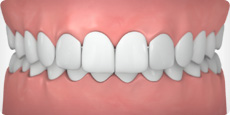 get straight teeth with invisible braces in Salt Lake City and Murray UT